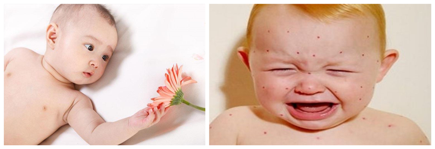 兒童濕疹反反復復，您有在家安裝家用除濕產(chǎn)品嗎？